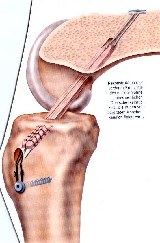 Schemadarstellungen der Kreuzbandoperation